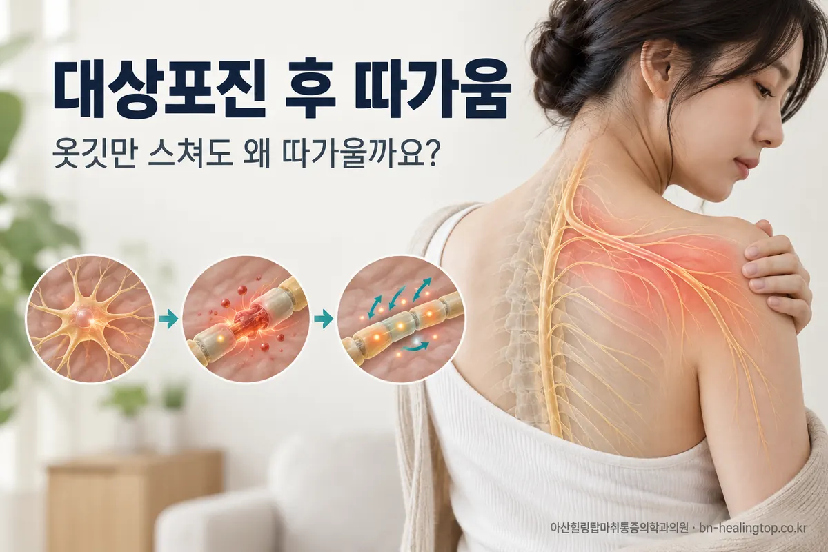 대상포진 발진은 나았는데 왜 계속 따가울까요