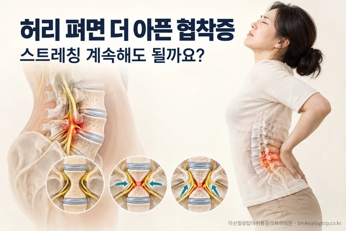 허리를 펴면 더 아픈 척추협착증, 스트레칭은 계속해도 될까요?